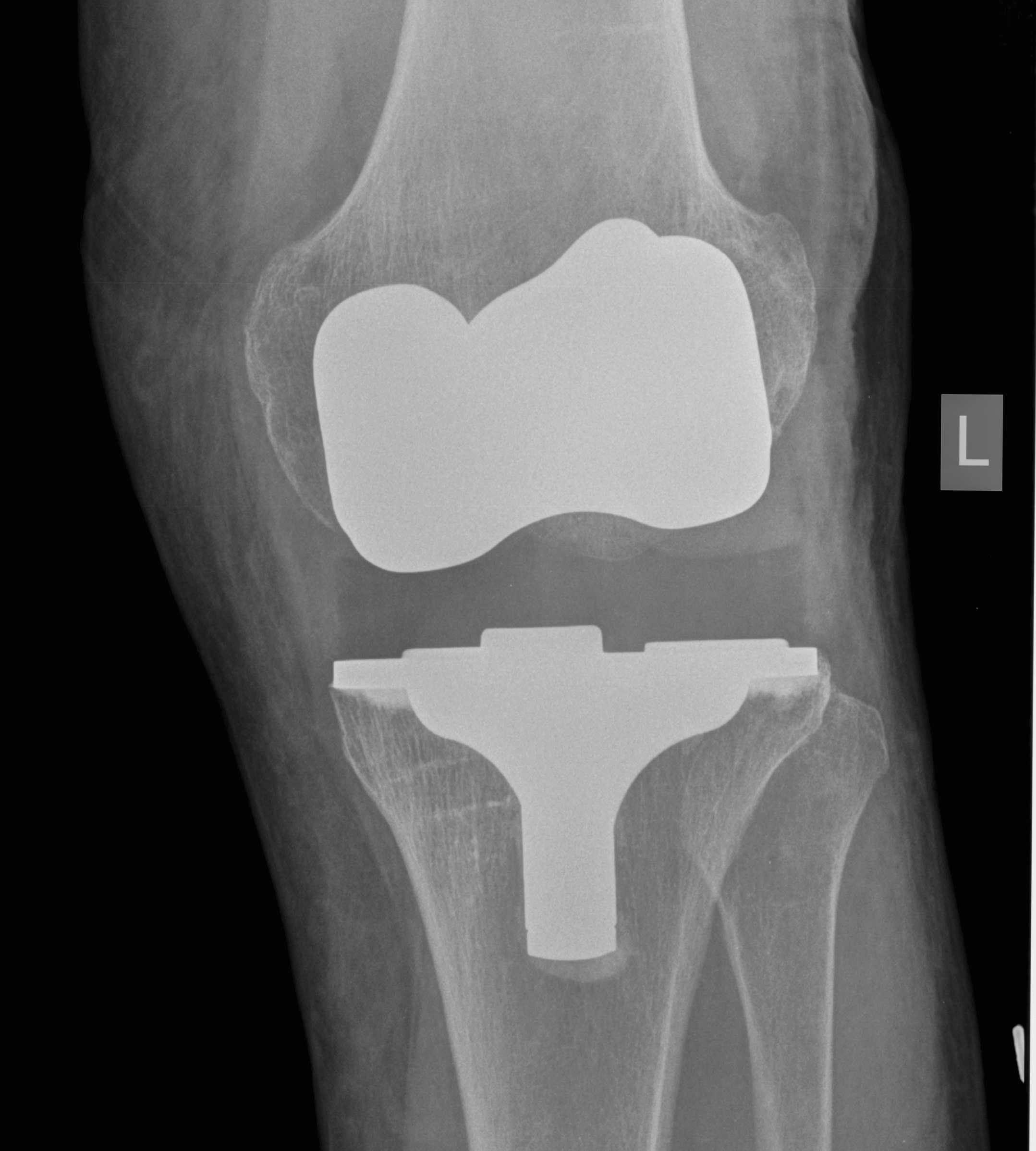 TKR Varus Coronal Instability 